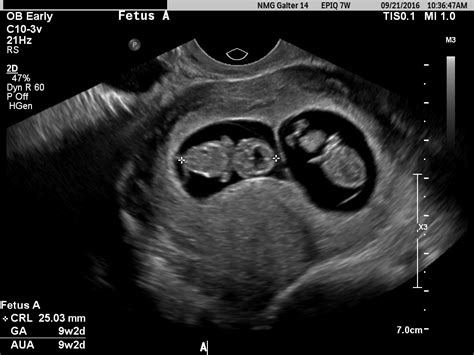 first dating ultrasound